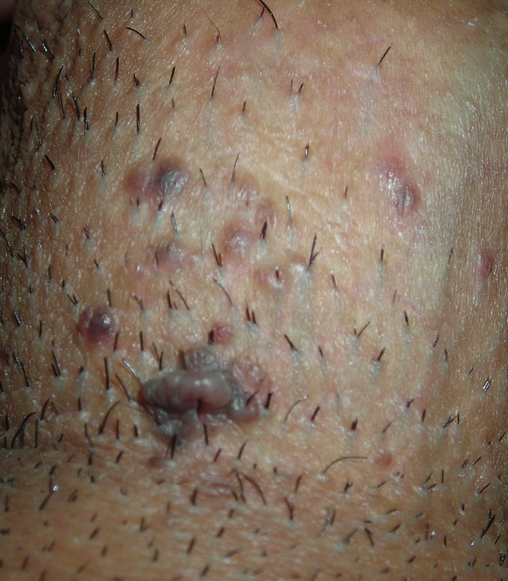 bowenoid papulosis pictures #10